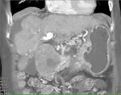 Hepatoma - CTisus CT Scan