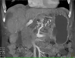 Cirrhosis With Varices - CTisus CT Scan