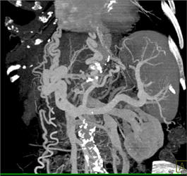 Cirrhosis With Varices - CTisus CT Scan