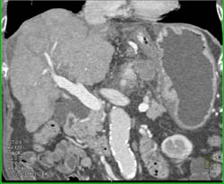 Cirrhosis and Varices - CTisus CT Scan