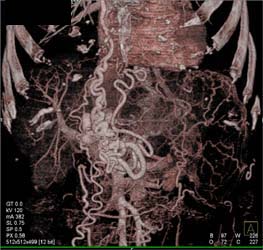 Nice Venous Collaterals - CTisus CT Scan