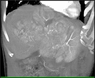 Hepatoma With Neovascularity - CTisus CT Scan