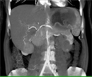 Hepatoma - CTisus CT Scan