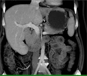 Hepatoma - CTisus CT Scan