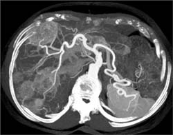 Metastatic Islet Cell Tumor of the Pancreas - CTisus CT Scan