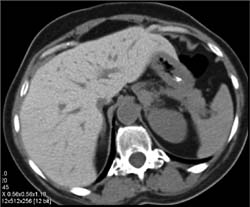 Amiodarone? Toxicity of the Liver - CTisus CT Scan