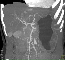 Hepatoma - CTisus CT Scan