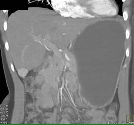 Hepatoma - CTisus CT Scan