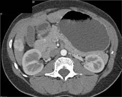 Hepatoma - CTisus CT Scan