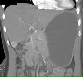 Hepatoma - CTisus CT Scan