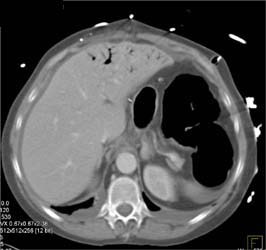 Ischemic Bowel With Portal Venous Air and Pnematosis - CTisus CT Scan