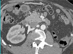 Hepatic Av Fistulae - CTisus CT Scan