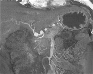 Hepatic Artery Aneurysms - CTisus CT Scan