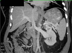 Spleno-renal Shunting - CTisus CT Scan