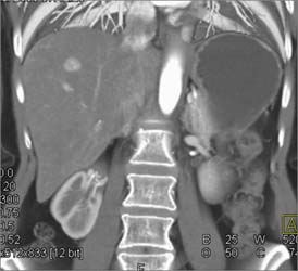 Focal Nodular Hyperplasia (FNH) - CTisus CT Scan