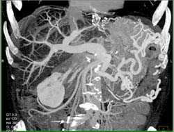 Huge Varices Due to Splenic Vein Occlusion - CTisus CT Scan