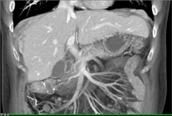 Implants on the Liver Due to Carcinoid Tumor - CTisus CT Scan