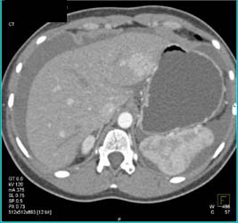 Focal Nodular Hyperplasia (FNH) With Early and Late Phase Imaging - CTisus CT Scan