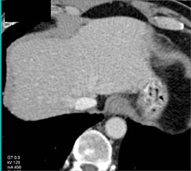 Flow Changes to Left Lobe - CTisus CT Scan