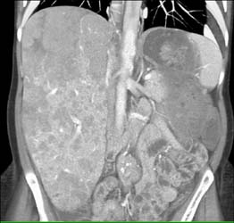 Sarcoidosis in the Liver - CTisus CT Scan