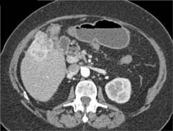 Cholangiocarcinoma - CTisus CT Scan