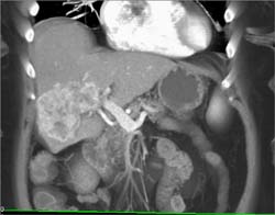 Cholangiocarcinoma - CTisus CT Scan