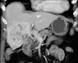 Cholangiocarcinoma - CTisus CT Scan