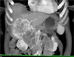 Cholangiocarcinoma - CTisus CT Scan