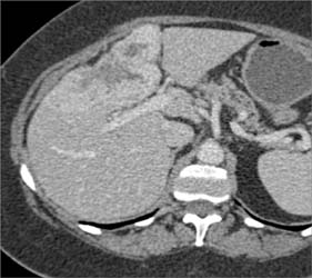 Cholangiocarcinoma - CTisus CT Scan