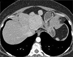 Hepatoma - CTisus CT Scan