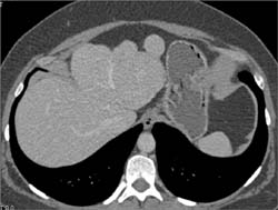 Hepatoma - CTisus CT Scan