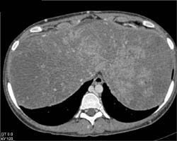 Regenerating Nodules in the Liver - CTisus CT Scan