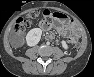 Collaterals Due to Cirrhosis and Portal Hypertension - CTisus CT Scan