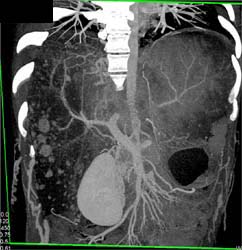 Regenerating Nodules - CTisus CT Scan