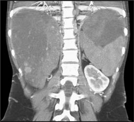 Regenerating Nodules - CTisus CT Scan