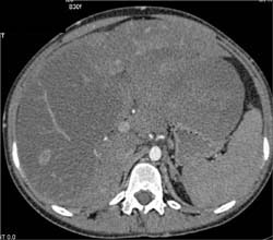 Regenerating Nodules - CTisus CT Scan