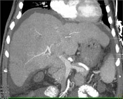 Cirrhosis - CTisus CT Scan