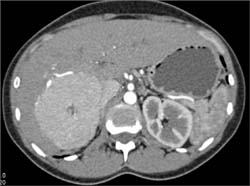 Focal Nodular Hyperplasia (FNH)-super Feeding Vessel - CTisus CT Scan