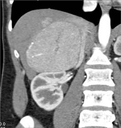 Regenerating Nodules - CTisus CT Scan