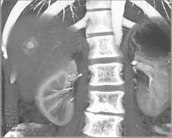 Metastatic Neuroendocrine Tumor - CTisus CT Scan