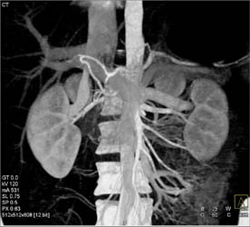 Unusual Anastomosis of Sma and Hepatic Artery in Potential Liver Donor - CTisus CT Scan