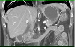 Carcinoid With Implants on the Liver and Spleen - CTisus CT Scan