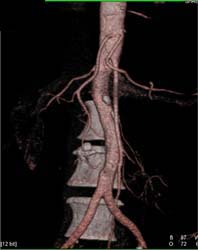 Splenic and Hepatic Artery Arise Directly Off Aorta - CTisus CT Scan