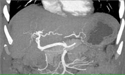 Cholangiocarcinoma - CTisus CT Scan