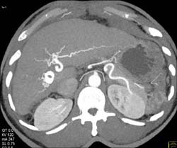 Neovascularity in Cirrhotic Liver With Transjugular Intrahepatic Portosystemic Shunt (TIPS) - CTisus CT Scan