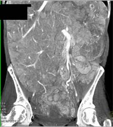 Metastatic Carcinoid Tumor - CTisus CT Scan