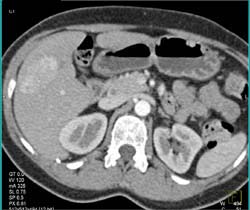 Hepatoma - CTisus CT Scan