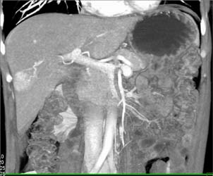 Hepatoma - CTisus CT Scan