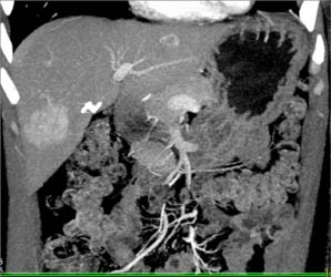 Hepatoma - CTisus CT Scan