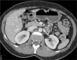 Hepatoma - CTisus CT Scan